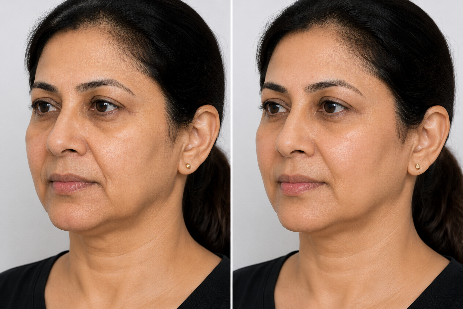 VOLFORMER skin lifting results at Dr. Marwah's Clinics Mumbai, jawline and neck before and after